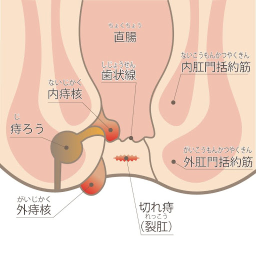 痔瘻（あな痔）